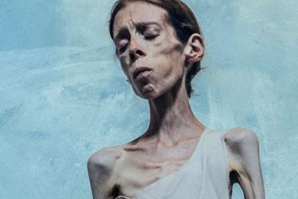 Kunstner Lene Marie Fossen (33)er død.Hun døde natt til tirsdag etter å ha slitt med anoreksi i over 20 år.